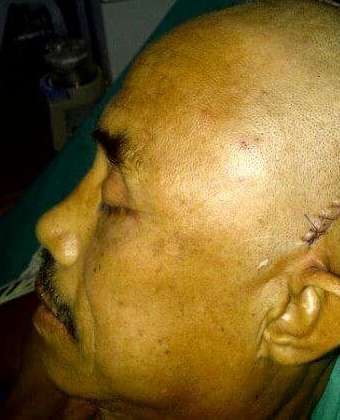 Alcohol use is one of the major causes of head injuries in Nepal