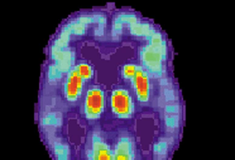Single brain scan can diagnose Alzheimer's disease thumbnail
