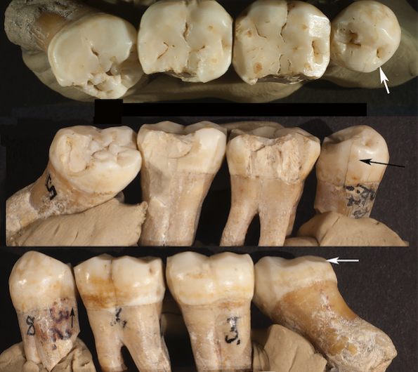 Analysis of Neanderthal teeth grooves uncovers evidence of prehistoric dentistry