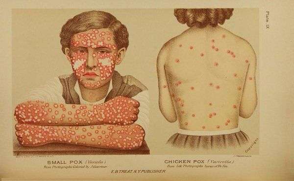 A Necessary Retelling of the Smallpox Vaccine Story