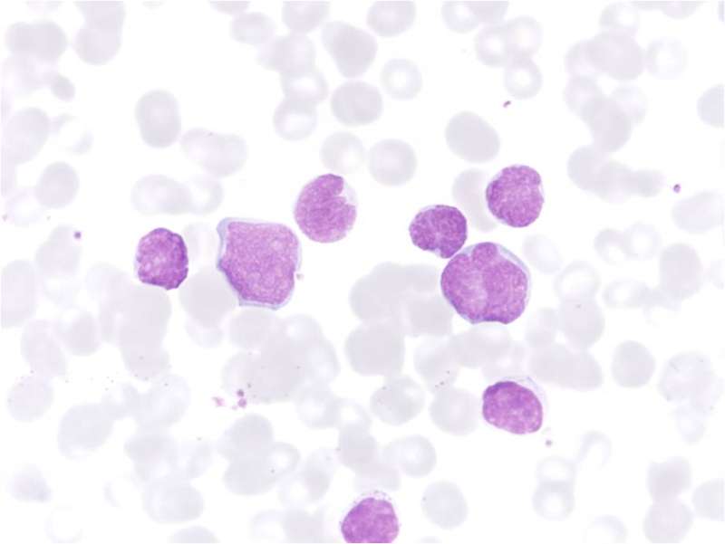 An epigenetic lesion could be responsible for acute T-cell leukemia