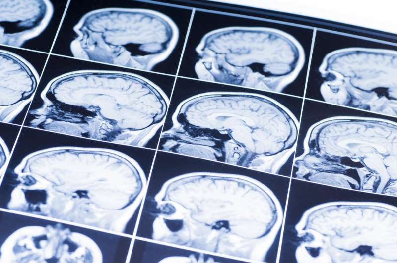 A non-invasive method to detect Alzheimer's disease