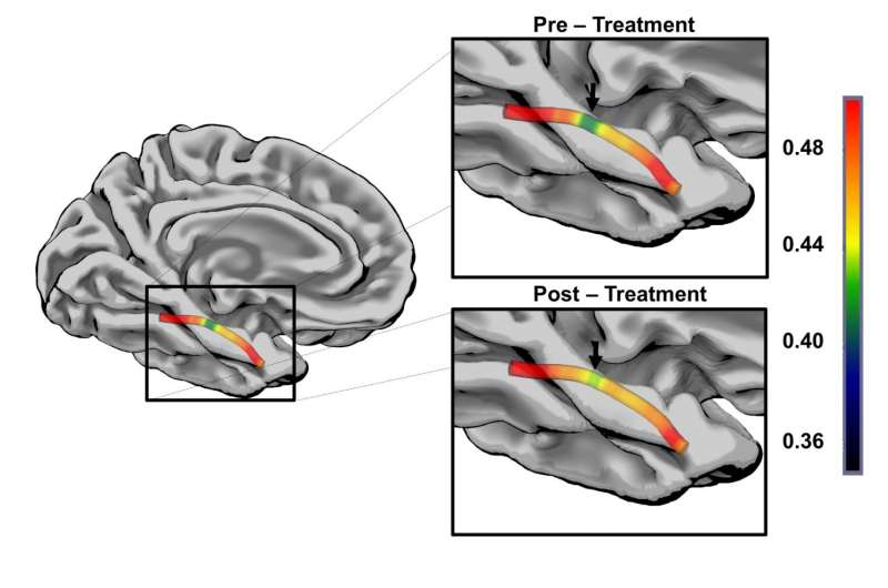 Aphasia recovery via speech therapy related to structural plasticity of the ventral stream