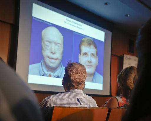 Are face transplants still research, or regular care?
