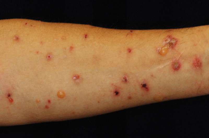 A risk factor for drug-induced skin disease identified