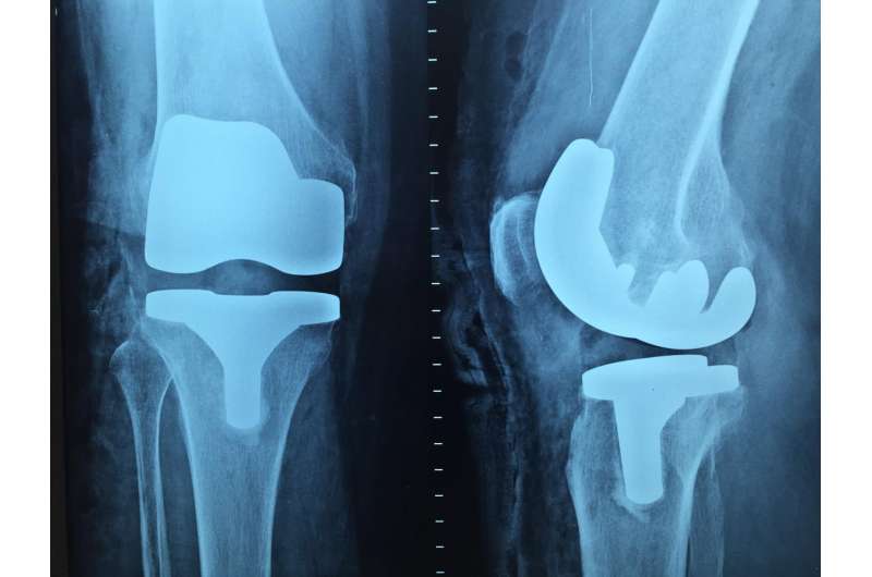 As US scrutinizes joint replacements, study finds no way to predict risk