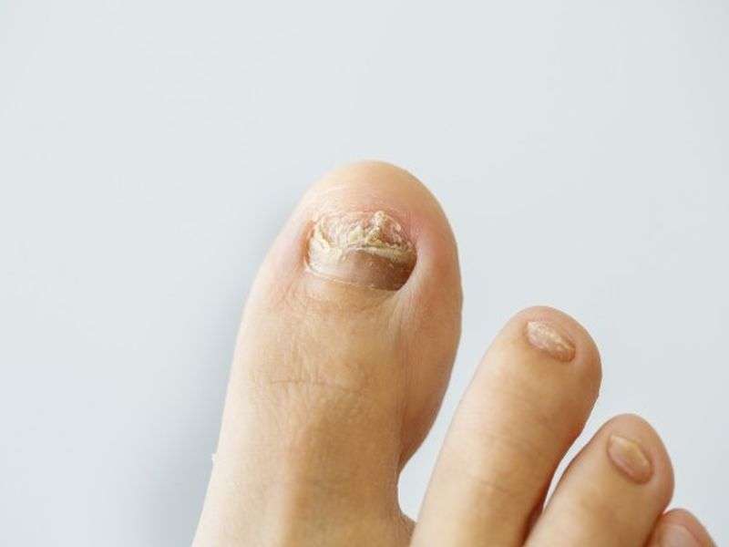 Avoid unsightly fungal toenail infections