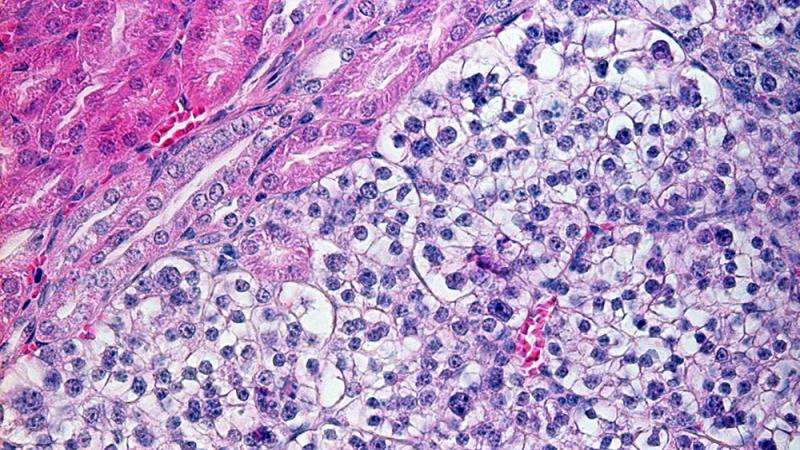 Better treatment for kidney cancer thanks to new mouse model