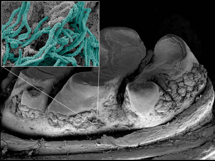 Blocking yeast-bacteria interaction may prevent severe biofilms that cause childhood tooth decay