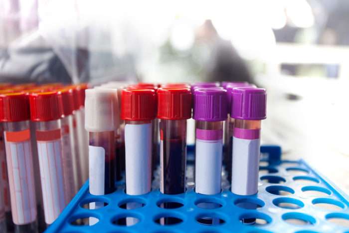 Blood test identifies key Alzheimer's marker