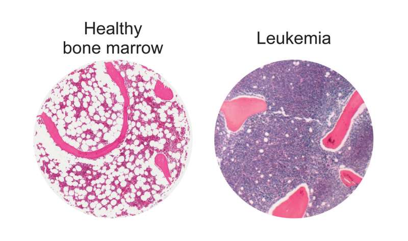 Bolstering fat cells offers potential new leukemia treatment