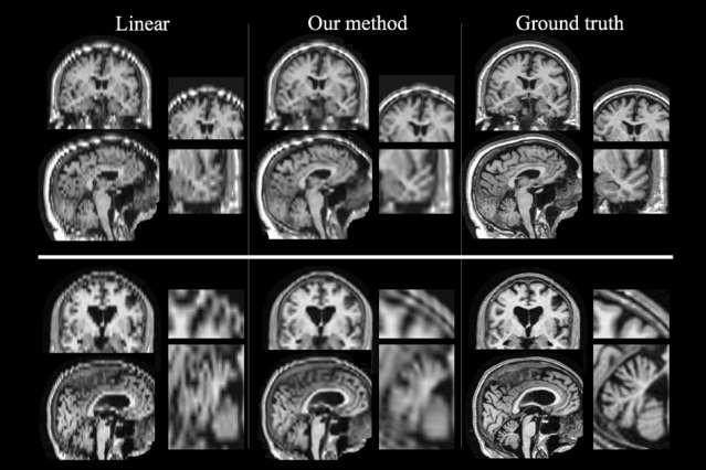 Boosting quality of patient MRIs could enable large-scale studies of stroke outcome