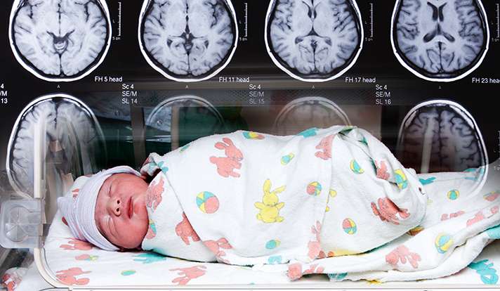 Brain impairments in premature infants may begin in the womb