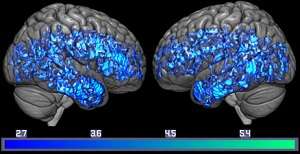 Brain scan study adds to evidence that lower brain serotonin levels are linked to dementia