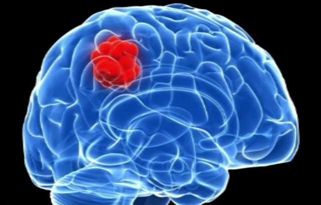 Brain tumour’s 'addiction' to common amino acid could be its weakness