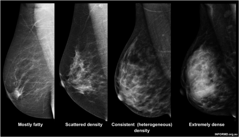 乳房密度研究边缘更接近癌症预防