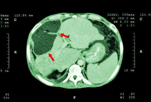 Cause of cancer form in the liver identified