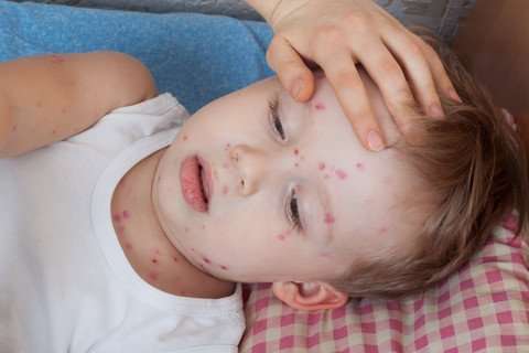 Chickenpox virus fatal in newly discovered immunodeficiency