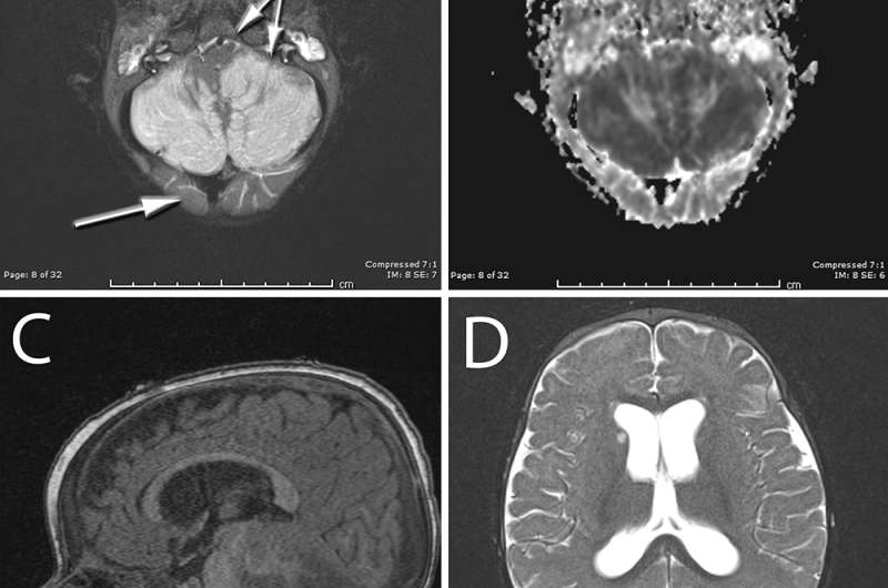 Clinical appearance and unusual imaging findings of pediatric ketamine overdose