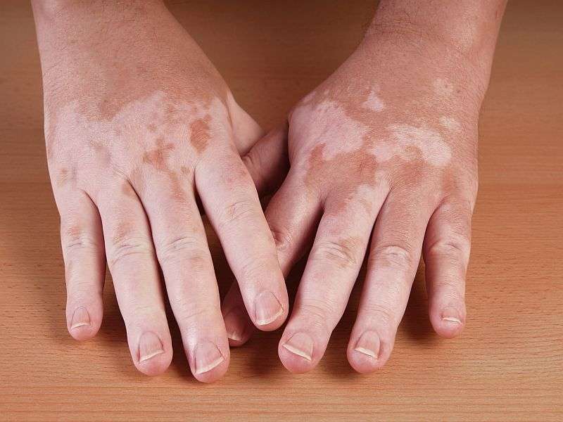 Clinical features of vitiligo linked to age of disease onset