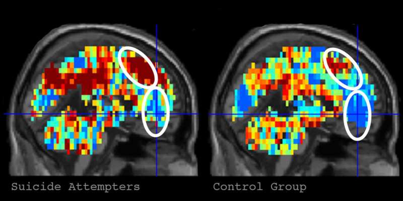 CMU and Pitt brain imaging science identifies individuals with suicidal thoughts