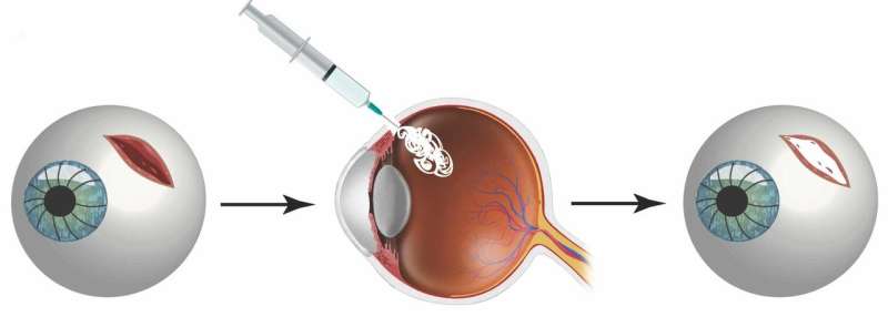Combating eye injuries with a reversible superglue seal