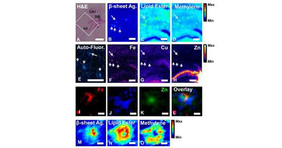 Combined imaging approach characterises plaques associated with Alzheimer’s disease