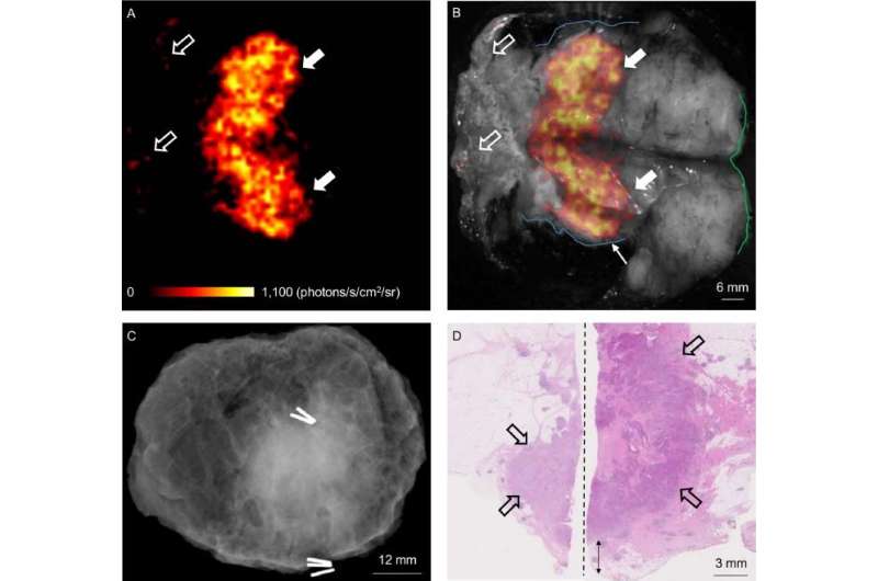 Combined optical and molecular imaging could guide breast-conserving surgery