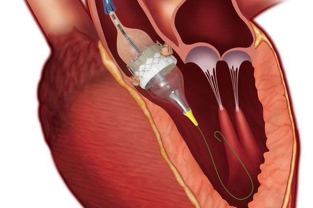 Conscious sedation is a safe alternative to general anesthesia for heart valve procedure