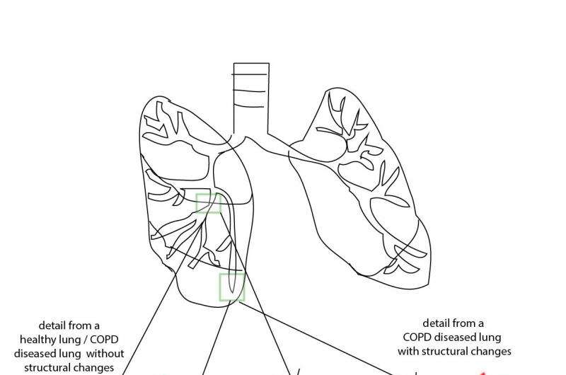 COPD – changes in the lungs, changes in the microbiome