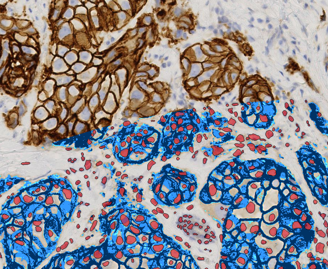 Digital pathology platforms can now determine the metastatic potential of cells in a tissue biopsy