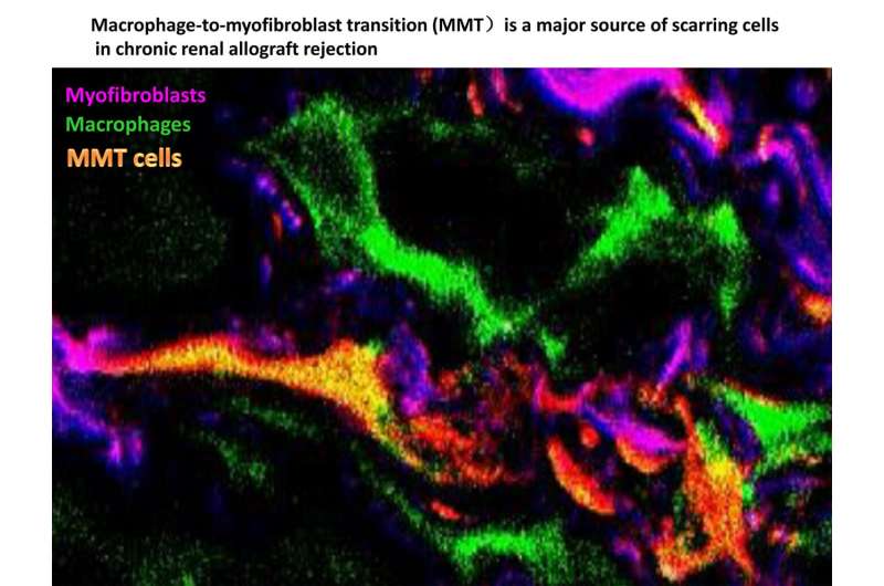Discovery may help prevent tissue scarring and rejection of transplanted kidneys