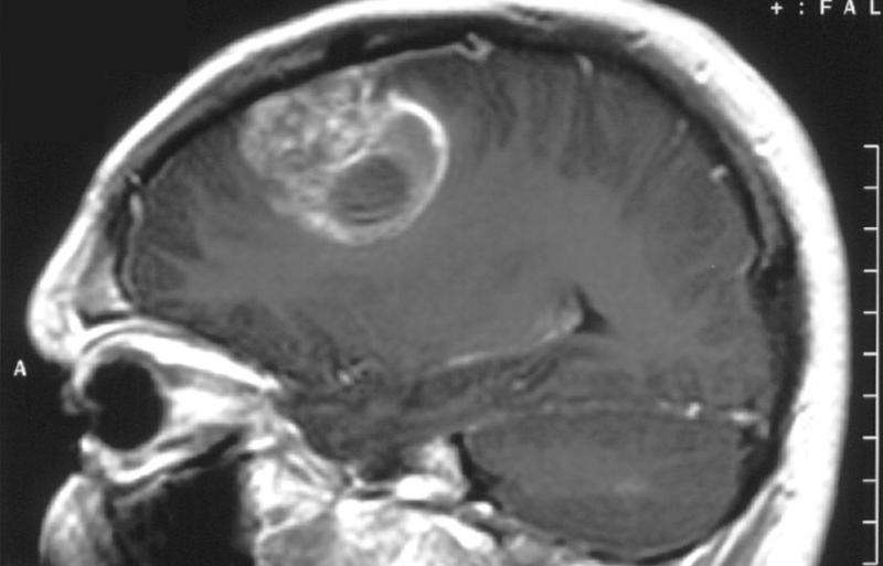 DNA becomes primary target in fight against glioblastoma
