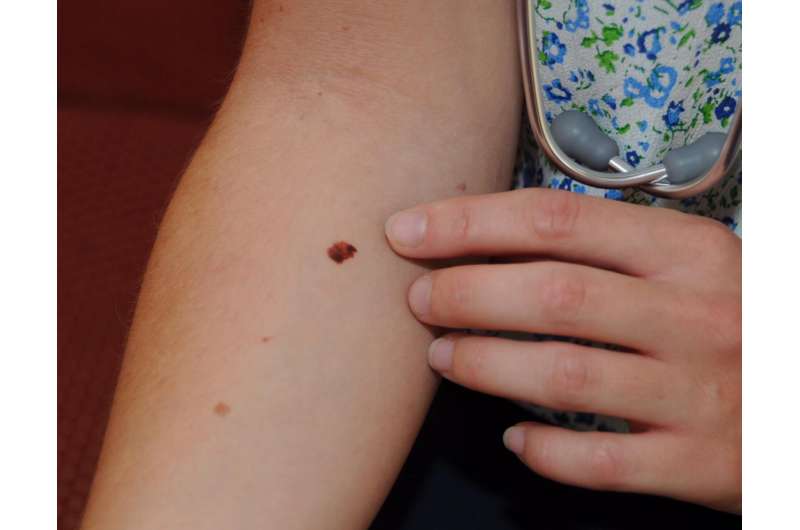 Doctors gain a greater understanding of skin cancer using tattoos