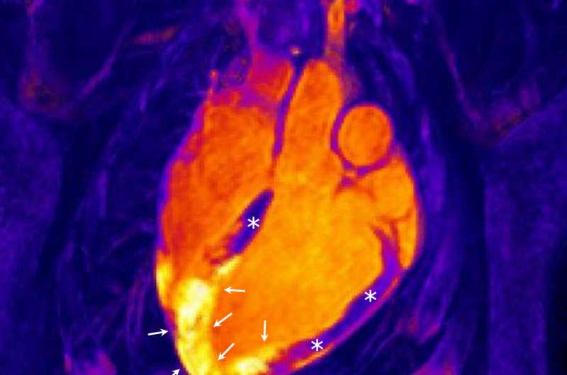 教条翻倒：梗死的心脏中炎症的新研究可能导致治疗的变化