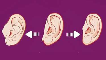Do your ears hang low? The complex genetics behind earlobe attachment