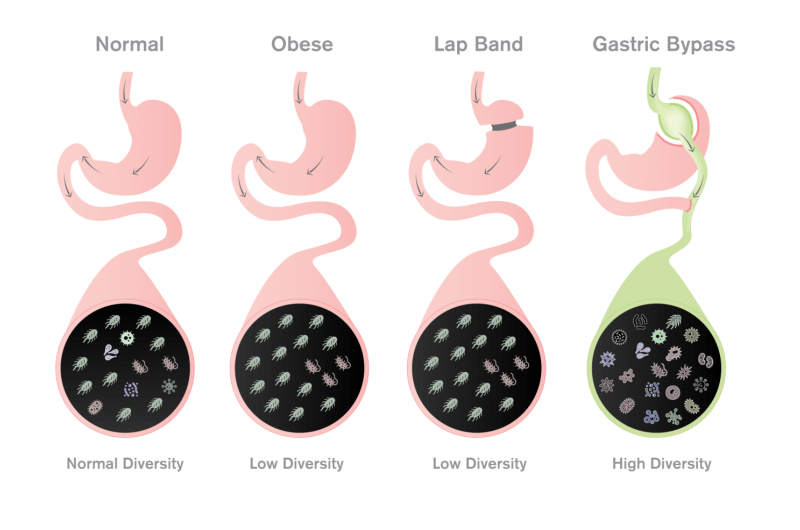 Dramatic shift in gut microbes and their metabolites seen after weight loss surgery