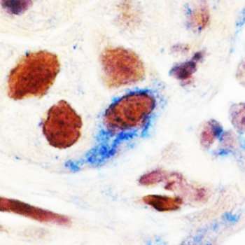 Drug suppresses spread of breast cancer caused by stem-like cells