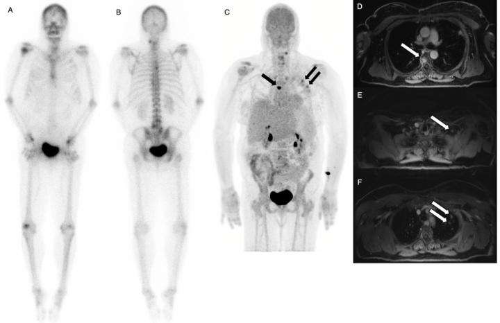 Dual-agent PET/MR with time of flight detects more cancer