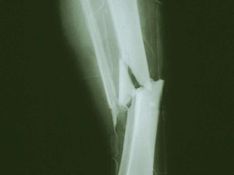 Effect of osteoporotic fractures similar to diabetes burden