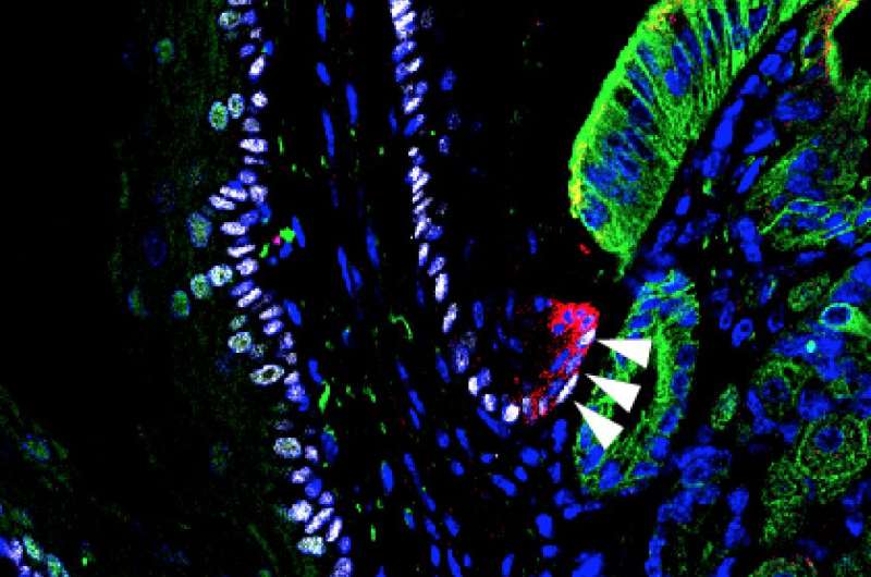 Esophageal cancer 'cell of origin' identified