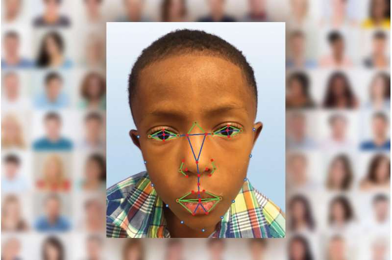 面部识别软件帮助诊断罕见的遗传性疾病