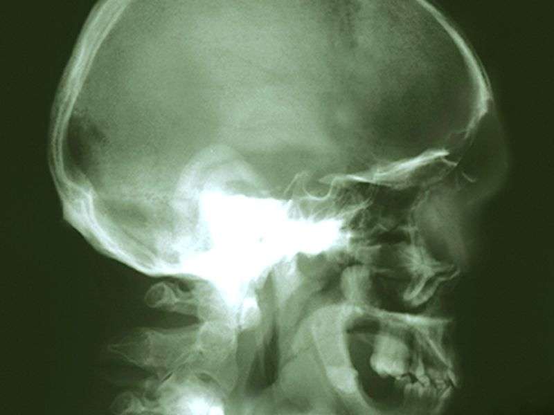 Few skull radiation patients show cognitive impairment