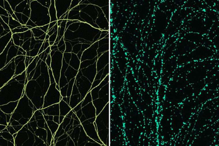 Findings suggest ways to block nerve cell damage in neurodegenerative diseases