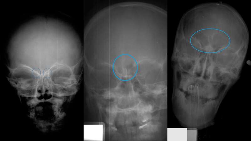 Forensic technique uses forehead X-rays to assess age of juvenile remains