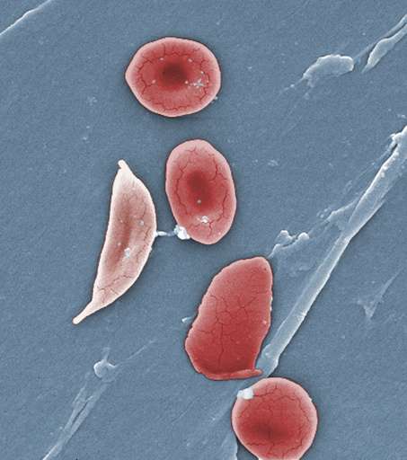 Gene therapy lets a French teen dodge sickle cell disease