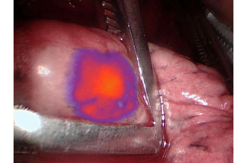 Glowing tumor technology helps surgeons remove hidden cancer cells