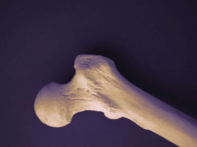 High dietary fiber protects against femoral neck bone loss