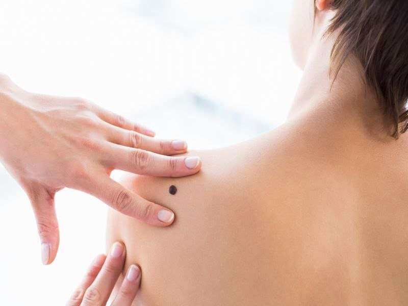 How to do a skin cancer body check