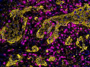 Immune cells localized near pancreatic cancer cells have altered metabolism, could promote cancer